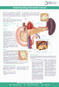 Pancreatic cancer